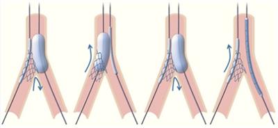 Six-months clinical and intracoronary imaging follow-up after reverse T and protrusion or double-kissing and crush stenting for the treatment of complex left main bifurcation lesions